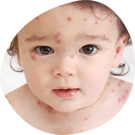 Children acne